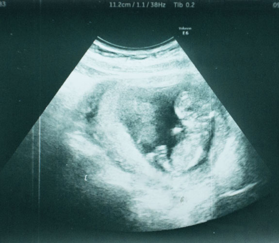 胎児エコー写真